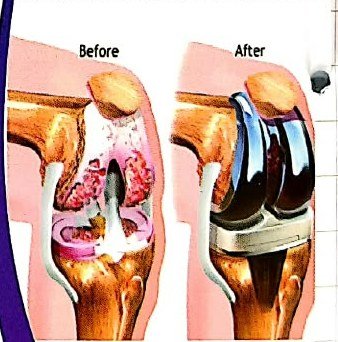 Knee replacement before and after